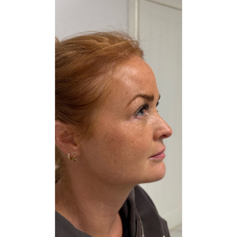 image comparison after